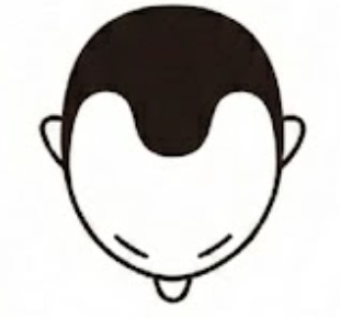 生え際〜M字（広範囲）