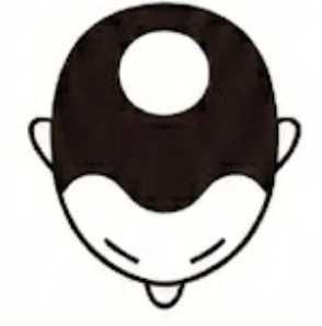 生え際〜M字＋頭頂部